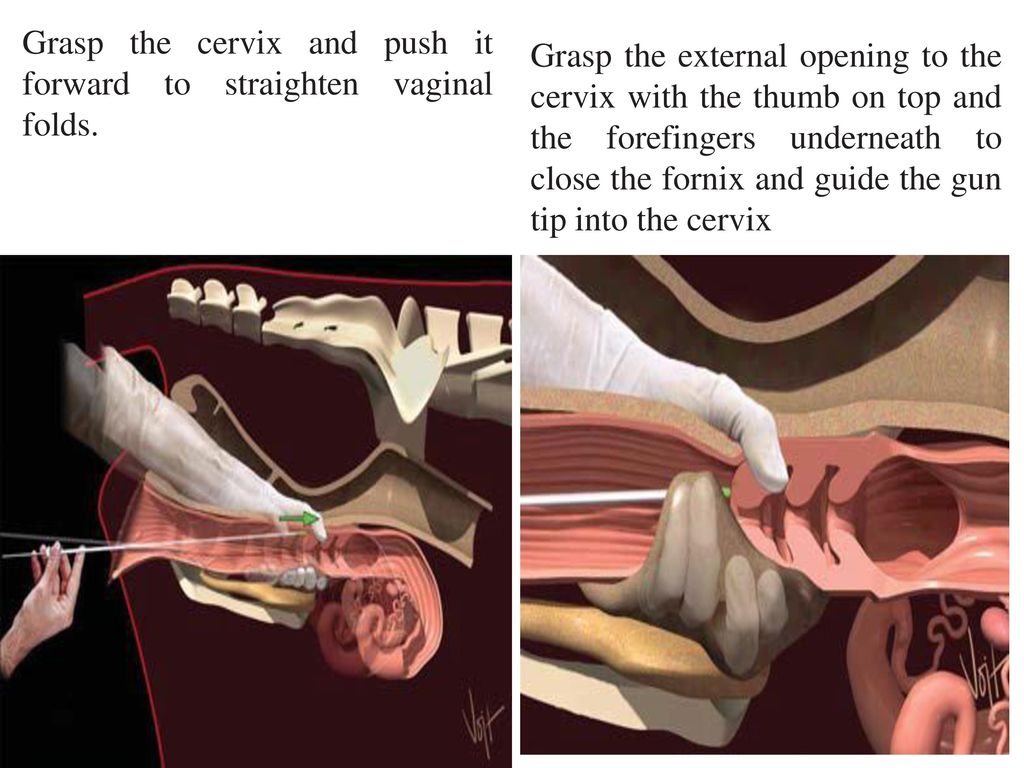 insertion gun vaginal hand